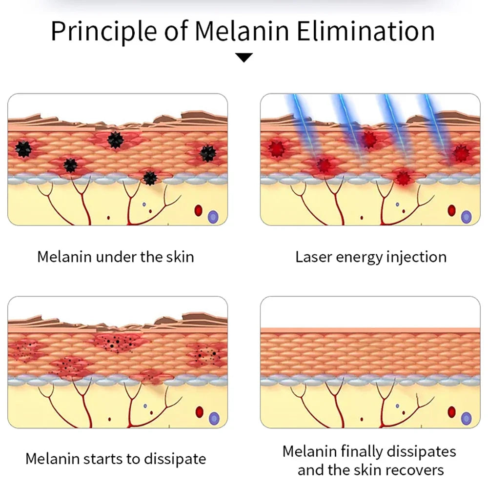 Picosecond Laser Pen Tattoo Removal Machine and Pigment Scar Freckle Mole Eyebrow Remove Black Dots Melanin Face Skin Care Tools