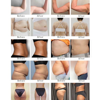 Upgrades Lipo System 10d Lipo Green Laser 532nm Green Light Laser Arm Fat Removal 10d 532nm Emerald Laser