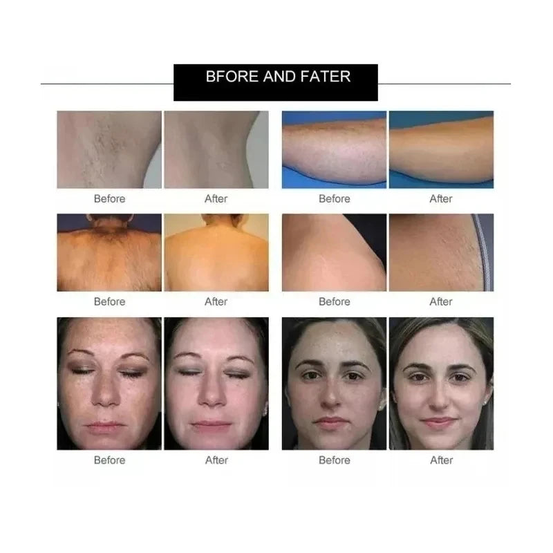 Professional 808nm Diode Laser 3500w High Power 755 808 1064nm Laser Painless Freezing Point Eepilation for Women