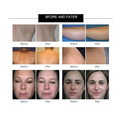 Professional 808nm Diode Laser 3500w High Power 755 808 1064nm Laser Painless Freezing Point Eepilation for Women