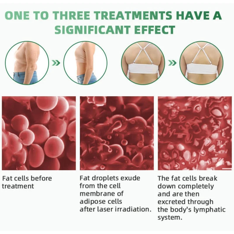 Upgrades Lipo System 10d Lipo Green Laser 532nm Green Light Laser Arm Fat Removal 10d 532nm Emerald Laser