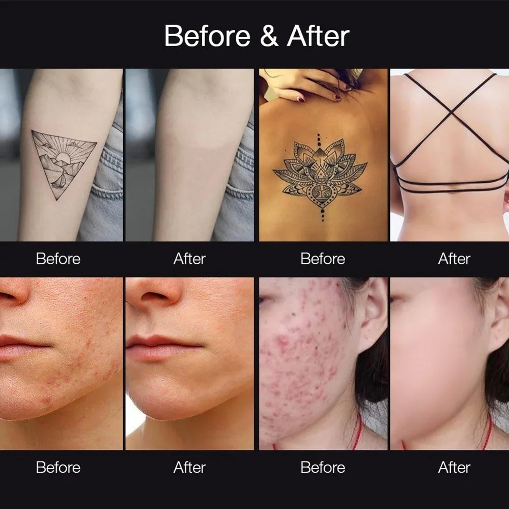 Picosecond Laser Pen Tattoo Removal Machine and Pigment Scar Freckle Mole Eyebrow Remove Black Dots Melanin Face Skin Care Tools