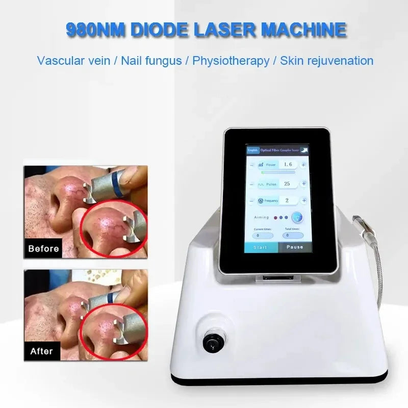 High Quality 980nm Diode Vascular Removal Laser System Spider Net Removal Machine for Face Red Blood Streak